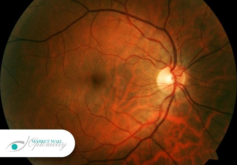 How Retinal Imaging Protects Eye Health in Calgary Residents